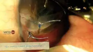 Ophtalmologie chirurgie oeil perforé.m4v