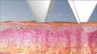 Mezotix™