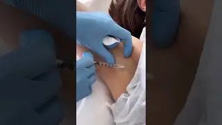 Коррекция повышенного потоотделения 🥵
