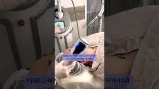 Лифтинг лица с Эндосферой! #shortvideo #косметология #обнинск #эндосфера #лифтинглица  #ототеков