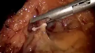 Pâncreas: Cirurgia de Whipple Laparoscópica/Robótica