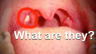 What Are Those Nasty White Chunks in Your Throat?