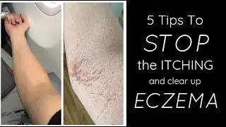 HEALING ECZEMA - 5 Things I Do Each Day To STOP THE ITCH