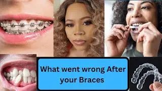 Why do Teeth shift after Braces??? | Ask Dr. Precious