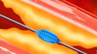 Coronary artery surgery #coronaryartery #heartvalve #heartsurgerysurvivor #heartvideo #coronaryheart