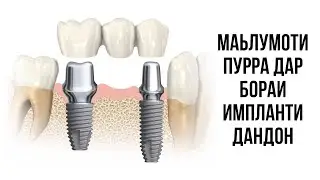 Маълумоти пурра дар бораи импланти дандон