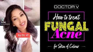 Doctor V - How To Treat Fungal Acne For Skin Of Colour | Brown Or Black Skin | 