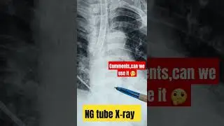 NG tube positioning || coiled tube | #nasogastrictube #tubing #xrays #chestxray #shorts #viral