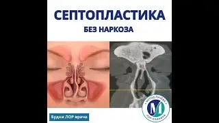 Септопластика под местной анестезией.