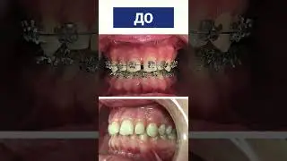 Braces before/after