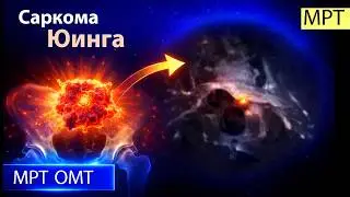 Саркома Юинга на МРТ