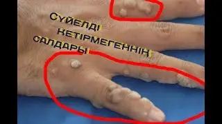Сүйелді кетірмесек не болады? ШОК
