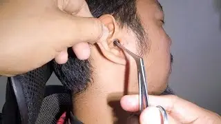 Removing Something BLACK Stuck in Man's Ear