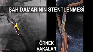 Şah Damarındaki (Karotis) Darlığın Stent ile Ameliyatsız Açılması: Örnek Vakalar