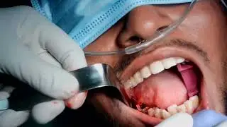 Broken Rc treated extraction with replacement of  Norris single piece implant