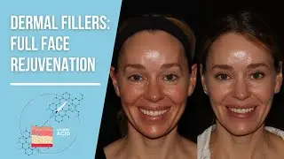 The Secrets to a Natural Look with Dermal Fillers