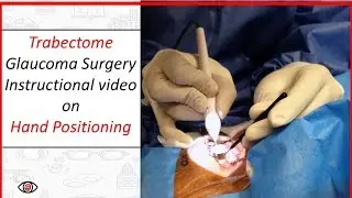 Trabectome Micro Invasive Glaucoma Surgery Instructional Video on Hand Positioning