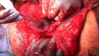 Mesh sutured technique for abdominal wall closure