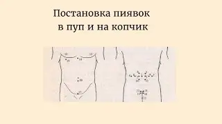 Постановка пиявок в пуп и на копчик