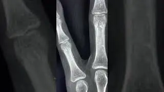 Potential pitfall for the fracture on plain radiographs