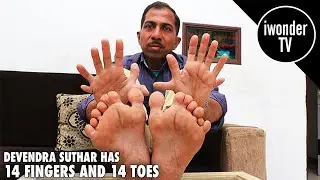 Guinness World Record Holder Has The Most Fingers And Toes In the World