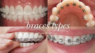 What Type of Braces Should I Choose? (Metal, Ceramic, Lingual, Invisalign)