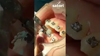 Brushing teeth with braces 