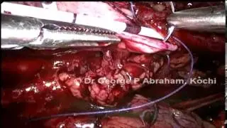 Laparoscopic Redo Pyeloplasty by Dr George P Abraham