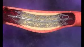 medical animation - stent opening blood flow