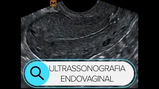 ULTRASSONOGRAFIA ENDOVAGINAL