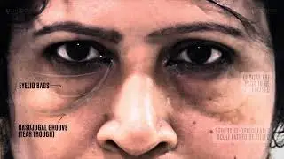 LOWER LID BLEPHAROPLASTY | UNDER EYES | CARRY BAGS | REVERSE AGEING | PLASTIC SURGERY | CONTOURS