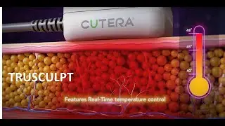 Fat Reduction - truSculpt by Cutera 2020 (Body Sculpting Medical Device 3D Animation)