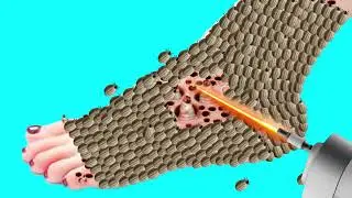 ASMR Treatment 2D Animation | Treating an Infection on the Foot | @HealAsmr914K