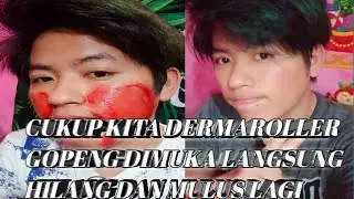 CUKUP DERMAROLLER DIRUMAH GOPENG DIMUKA KITA BISA KEMBALI MULUS LAGI