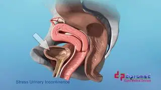 InGyne  MIS  - Treatment of the female stress urinary incontinence
