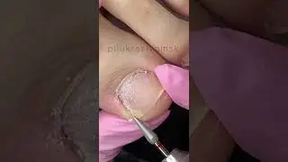 Обработка пальчиков фрезой капля 40 #педикюр #аппаратныйманикюр # #nails #nailtreatment #pedicure