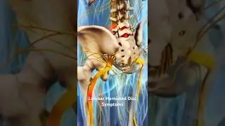 Lumbar Herniated Disc Symptoms