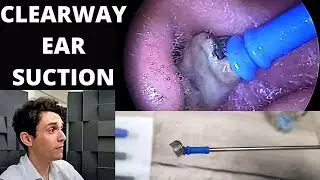Soft Tip Suction Probe Used to Extract Dead Skin From Ears (Clearway Suction Tool)