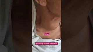 what can be causes of calcified, hard swelling infront of neck in 60 year old male. 
