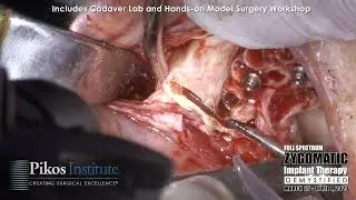 Apical Extent of Zygomatic Implant Osteotomy DeMystified
