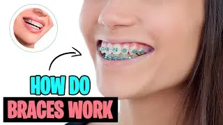 How do Dental Braces Work?