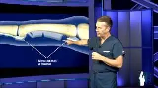 Flexor Tendon Surgery