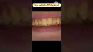Say Goodbye to Yellow Teeth: Banana Peel Teeth Whitening#shorts