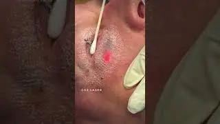 CO2 laser treatment for upper and lower eyelids 