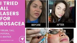 ROSACEA LASER - I TRIED ALL LASERS  on 2 CONTINENTS/ 3 COUNTRIES || VBEAM E-MATRIX YAG FOTONA