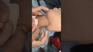 cannulation.. part 587 
