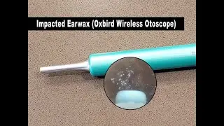 Impacted Earwax (Oxbird Wireless Otoscope)