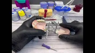Цирконевые коронки на имплантатах#стоматология#ярославль#зубы#master#dentist#имплантациязубов