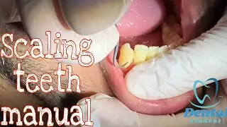Scaling teeth manual || Instruments  شرح عربي بسيط