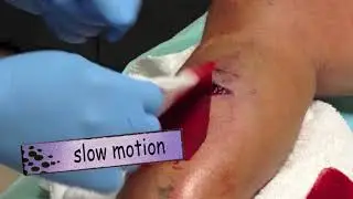 Artery Bleed